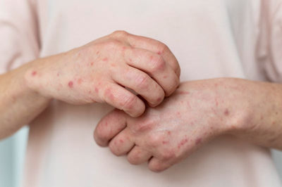 Contact Dermatitis and How to Treat It